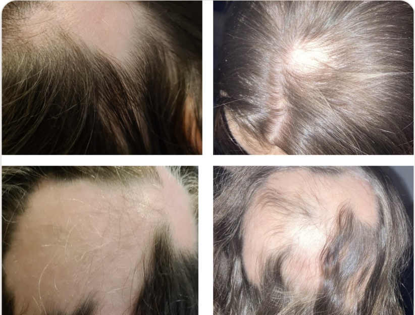 Hair Restoration